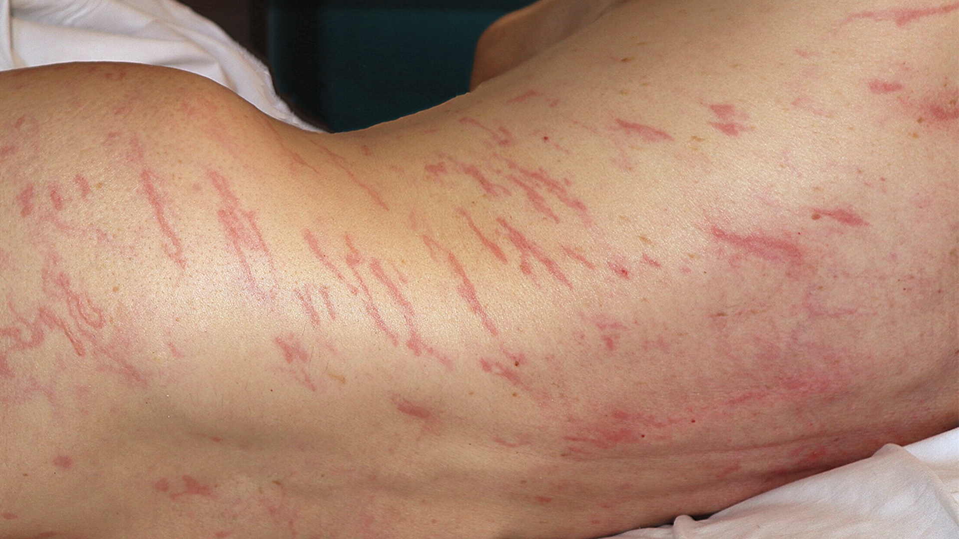 an image of a person with a skin condition showing parasites under their skin