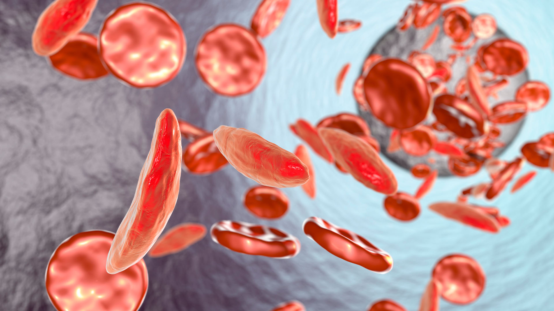 Sickle cell anaemia. Artwork showing normal red blood cells (round), and red blood cells affected by sickle cell anaemia (crescent shaped). This is a disease in which the red blood cells contain an abnormal form of haemoglobin (bloods oxygen-carrying pigment) that causes the blood cells to become sickle-shaped, rather than round. Sickle cells cannot move through small blood vessels as easily as normal cells and so can cause blockages (right). This prevents oxygen from reaching the tissues, causing severe pain and organ damage.