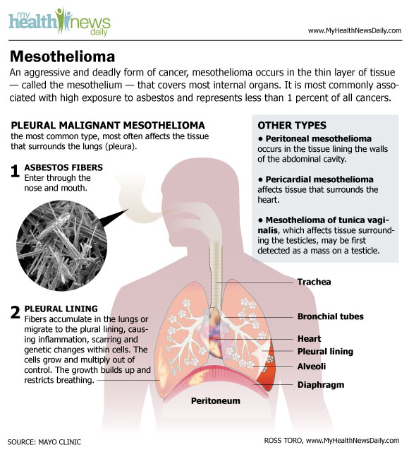 Mesothelioma is an aggressive form of cancer that occurs in a thin layer of tissue that covers most internal organs.