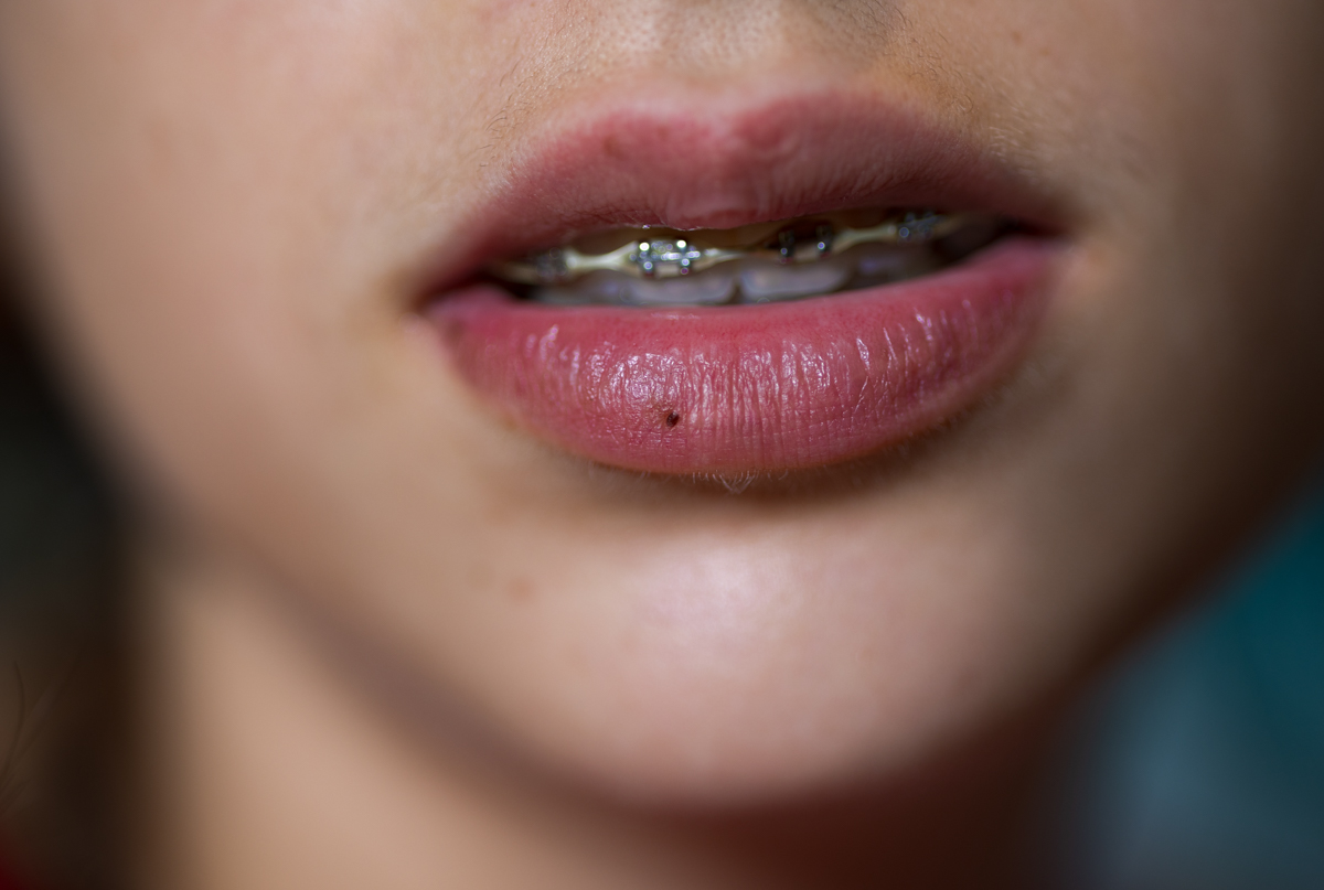 Close-up of lips with braces, showing a hint of pink lipstick and a small brown spot on the lower lip and a soft focus background