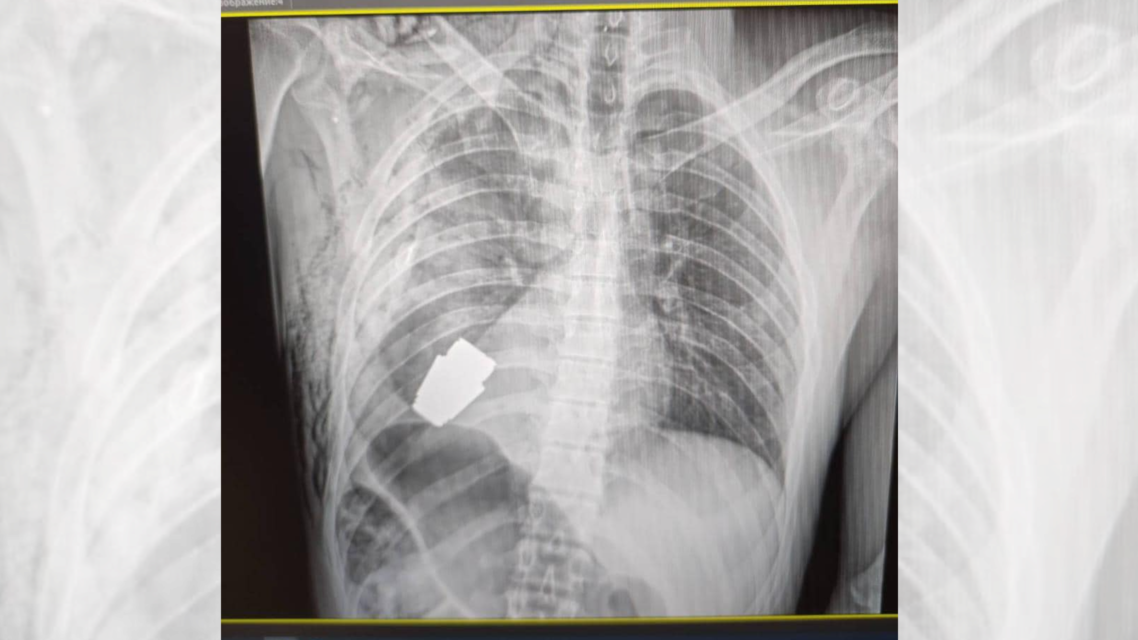An X-ray image of the unexploded grenade, lodged just below the soldier's heart. 